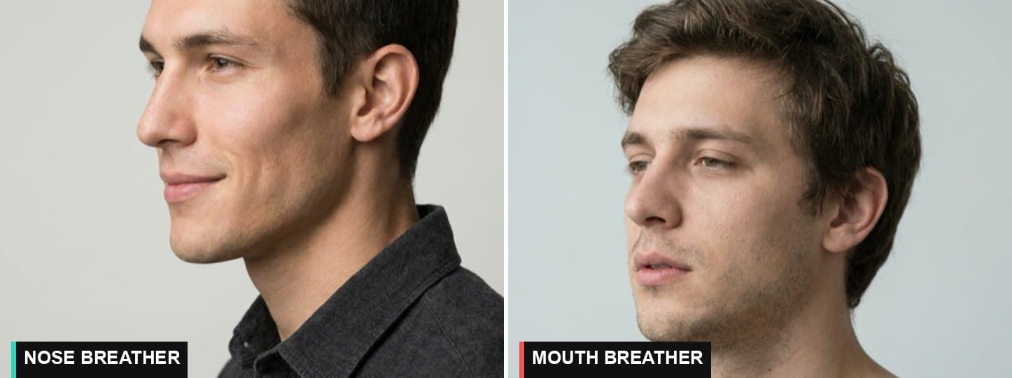 Nose breather profile with a forward jaw next to a mouth breather profile with a longer face